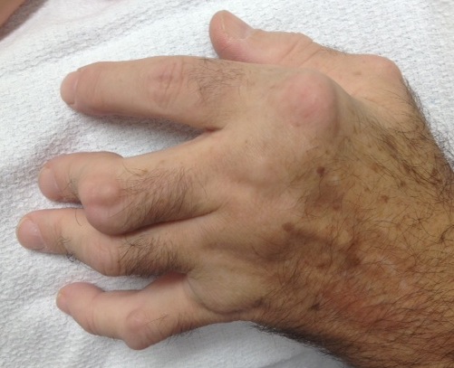 Rheumatoid Hand